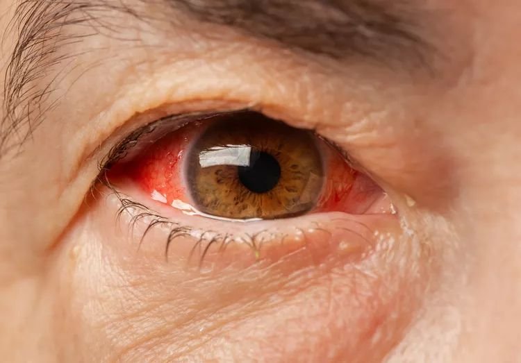 Pain and Redness in One Eye : What Your Red, Painful Eye Could Be Trying to Tell You!