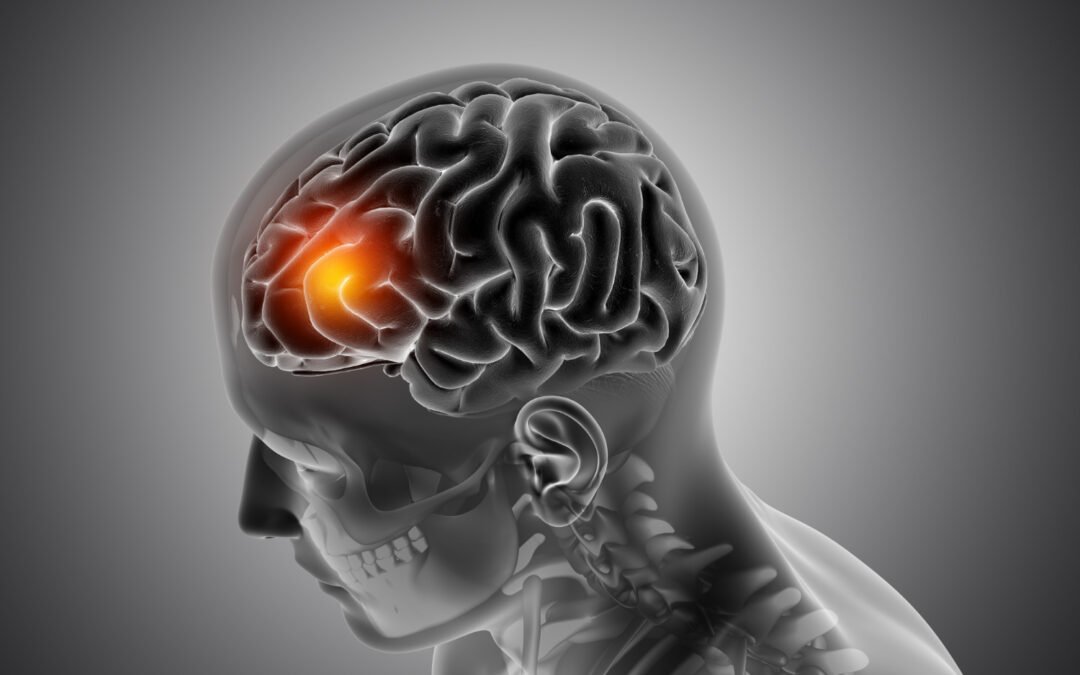 How to Detect a Stroke Before It’s Too Late